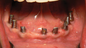 Final Fixed Prosthetic Options for Full Arch Implant Cases