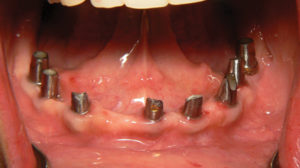  Final Fixed Prosthetic Options for Full Arch Implant Cases