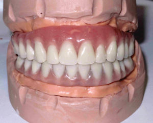 Final Fixed Prosthetic Options for Full Arch Implant Cases