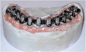 Final Fixed Prosthetic Options for Full Arch Implant Cases