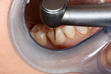 Initial finishing is performed with an EF 9 composite finishing bur after placing topical anesthetic.