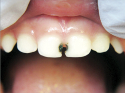 Primary teeth after 38% SDF application.14