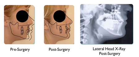 Patient underwent surgery to advance maxilla and mandible. Indicator line measurement ideal for adult female and Bolton norm superimposed on face shows ideal placement of both jaws. Airway is a massive 20 mm.