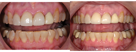 With a retracted view, the Nikon on the left has a slightly pinker soft tissue, with the Shofu camera on the right having slightly more yellow teeth.