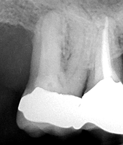 Independent access entry ports cut with dynamic guidance in this severely calcified molar.