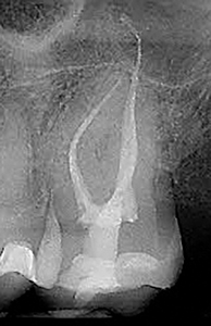 This post-operative radiograph shows a very diminutive access cavity opening with both mesial and distal lateral pulp horns unroofed during the RCT procedure and filled during the post-endodontic restorative effort – this appearance is a matter of pride among those in the “IBAC” club (courtesy Dr. Jeff Pafford).