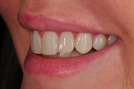 Un-retracted smile post-op left lateral view.