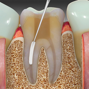 An aliquot of EndoSequence BC sealer is injected into the coronal and middle thirds of the root canal space using tips designed for the sealer cartridge.