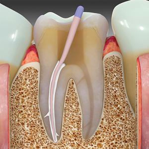 A 2-3 mm segment is removed from the coronal aspect of the GP cone. The cone is then buttered with sealer, reintroduced into the canal space and tapped to seating with a condenser. It is not advisable to use heat to remove the GP as it desiccates the bioceramic (SE).