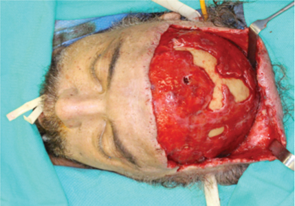 Intraoperative photo demonstrating variable areas of necrosis of the pericranium, galea aponeurotica and subcutaneous connective tissue. The unfavourable incision to access to the vertex of the skull was performed at an outside hospital centre prior to transferring the patient to our care.