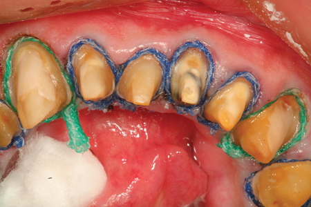 An occlusal view of a multiple unit prepared mandibular arch case after placement of the second retraction cords (#1 and # 2 UltraPak: Ultradent Products).