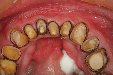 An occlusal view of the prepared arch from Figure 2 after removal of the top retraction cord. The fact that the entire second cord was visible around each preparation ensured that when pulled, 360 degrees of sulcus patency was available for the impression material to capture not only the preparation margin, but the root surface apical to the margin. The master die will now have critical emergence profile information for the dental technician to create a seamless restorative contour.