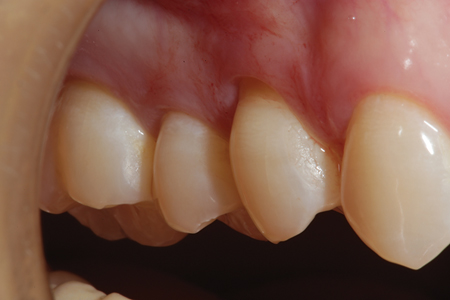 Tooth # 15 has an abfraction lesion on the facial surface to be restored. Since there is adequate keratinized free gingiva present, a diode laser can be used to make the gingival margin of the restored area supragingival facilitating placement of the restorative material.