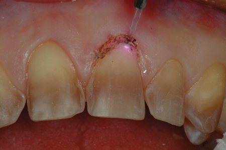 A diode laser is being used to perform aesthetic soft tissue recontouring to equalize the gingival heights of two maxillary central incisors prior to placing porcelain veneer restorations. It is important to note that a 1 mm sulcular depth must remain after the gingivectomy procedure is performed to maintain proper biologic width.