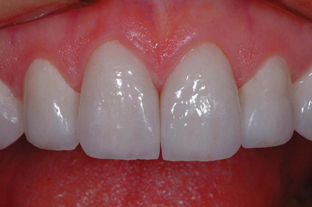 A postoperative view of the porcelain veneer restorations on the maxillary central incisor preparations shown in Figure 8. Note the quality of the marginal gingival health in the surgical area of tooth # 21 at only two weeks after the gingivectomy procedure performed with the super pulsed diode laser.