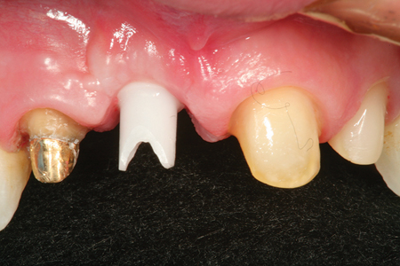 The provisional restoration has been removed to show how the gingival tissues have matured around the implant custom abutment simulating natural emergence profile.