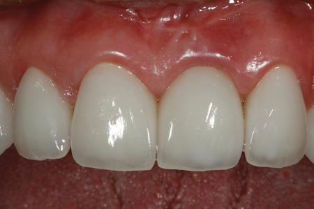 The definitive ceramic restorations after cementation. Note the gingival profiles, it is hard to pick which central incisor is an implant and which one is the natural tooth.