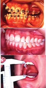 Case 1. (A) The pre surgical occlusion and maximum mouth opening, (B) the post treatment occlusion and, (C) the three-year post treatment mouth opening.