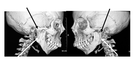 The severe bony re-ankylosis of this patient following costo-chondral graft three years previously is indicated by the black arrows. The bone plates used to secure the grafts are also partially covered by the bone (white arrows).