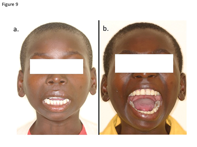 (A) The pre-surgical frontal view of a 14-year-old patient with left temporomandibular joint ankyloses. Mouth opening 4 mm, (B) post treatment frontal view demonstrating the increased mouth opening of 39 mm one-year following treatment.