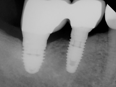 10 years post “delayed” implant replacement protocol.