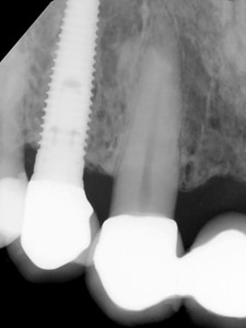 Radiographic view of successful implant (2.1 and 2.2) to tooth (1.3) rigid splint (20 years duration).