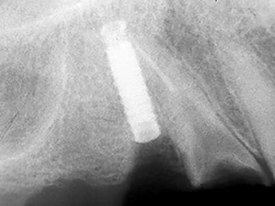 Five-year follow-up: Cuspid and implant have fractured.