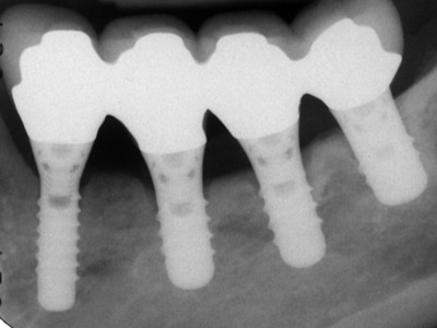 One year post restoration where implants at 34 and 36. Had poor initial stability.