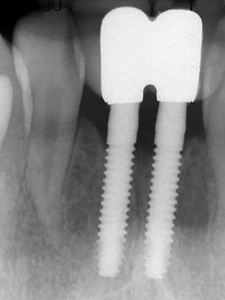 Narrow implants with limited mesio-distal space.
