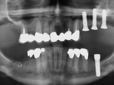 Dental implants: Mandibular neurovascular considerations 