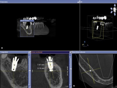 CT Scan demonstrates sufficient bone surrounding the fractured implant to allow for a wider diameter replacement.