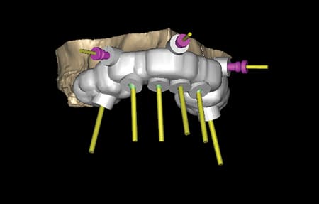 Computerized virtual surgical implant guide design.