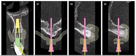 Implants individual position into the available bone volume and retaining anchor pins.