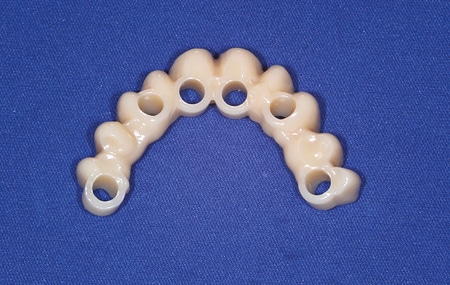 CAD CAM PMMA immediate fixed screw-retained prosthesis, fabricated from a 2D picture and a prototype positioning index.