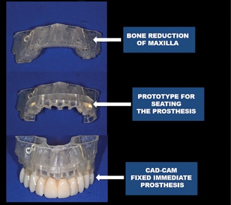 Build-up of the planning process: stereolithographic bone reduction of the maxilla loaded with the seating guide and the later loaded with the prosthetic PMMA bridge.