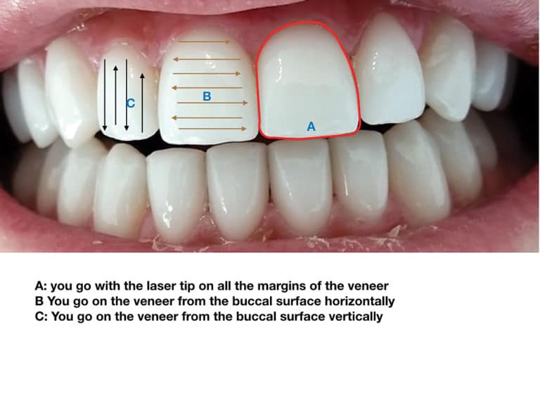A Novel Approach to Veneer Removal A Clinical Case Report Using Er,Cr