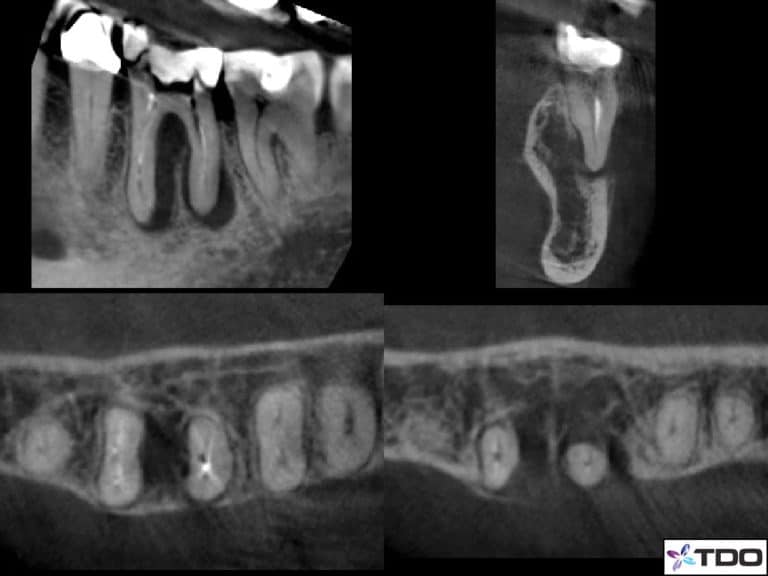 Managing Refractory Endodontic Disease With Radial Apical Cleansing (Report Of Two Clinical