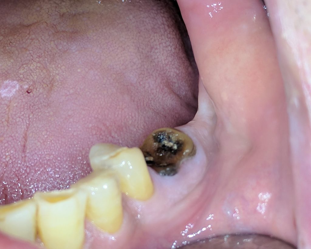 Immediate Implant A Case Report Oral Health Group