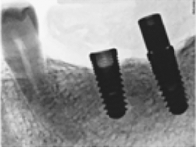 Damaged Prosthetic Screws