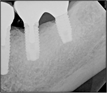 Initial presentation of the splinted crowns on 3.6 and 3.7. Notice the space between the abutment and fixture in site 3.6.