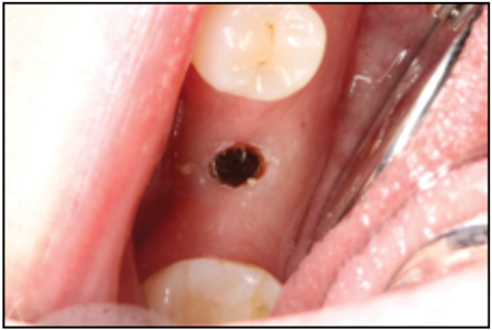 Implant was made accessible by laser removal of soft tissue overgrowth.