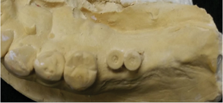 2 dental implants too close to each other and not prosthetically placed for ideal final implant prosthesis.