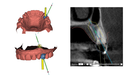 Surgical plan for guided implant surgery.