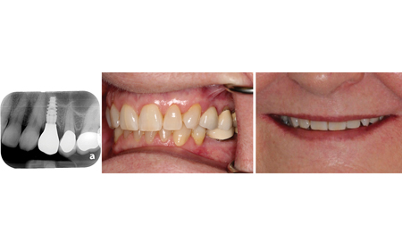 Radiographic and clinical appearance of the definitive, full contour ASC implant supported crown #24.