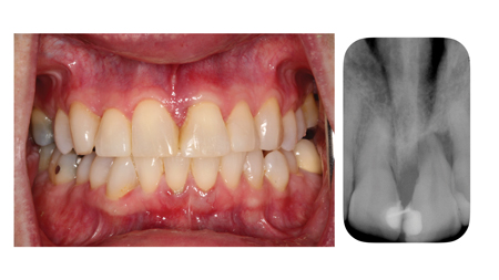 Severe circumferential bone loss affecting tooth 21.