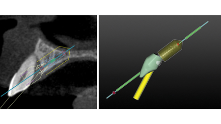 Surgical plan for guided implant surgery.