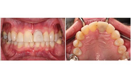 Clinical appearance at the four month post-op appointment.