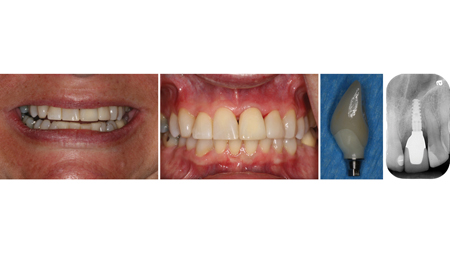 Radiographic and clinical appearance of the definitive, implant supported crown #21.