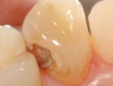 Silver Diamine Fluoride Unstained and Liberated - Oral Health Group