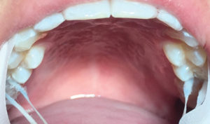 Clinical Uses for Silver Diamine Fluoride - Oral Health Group